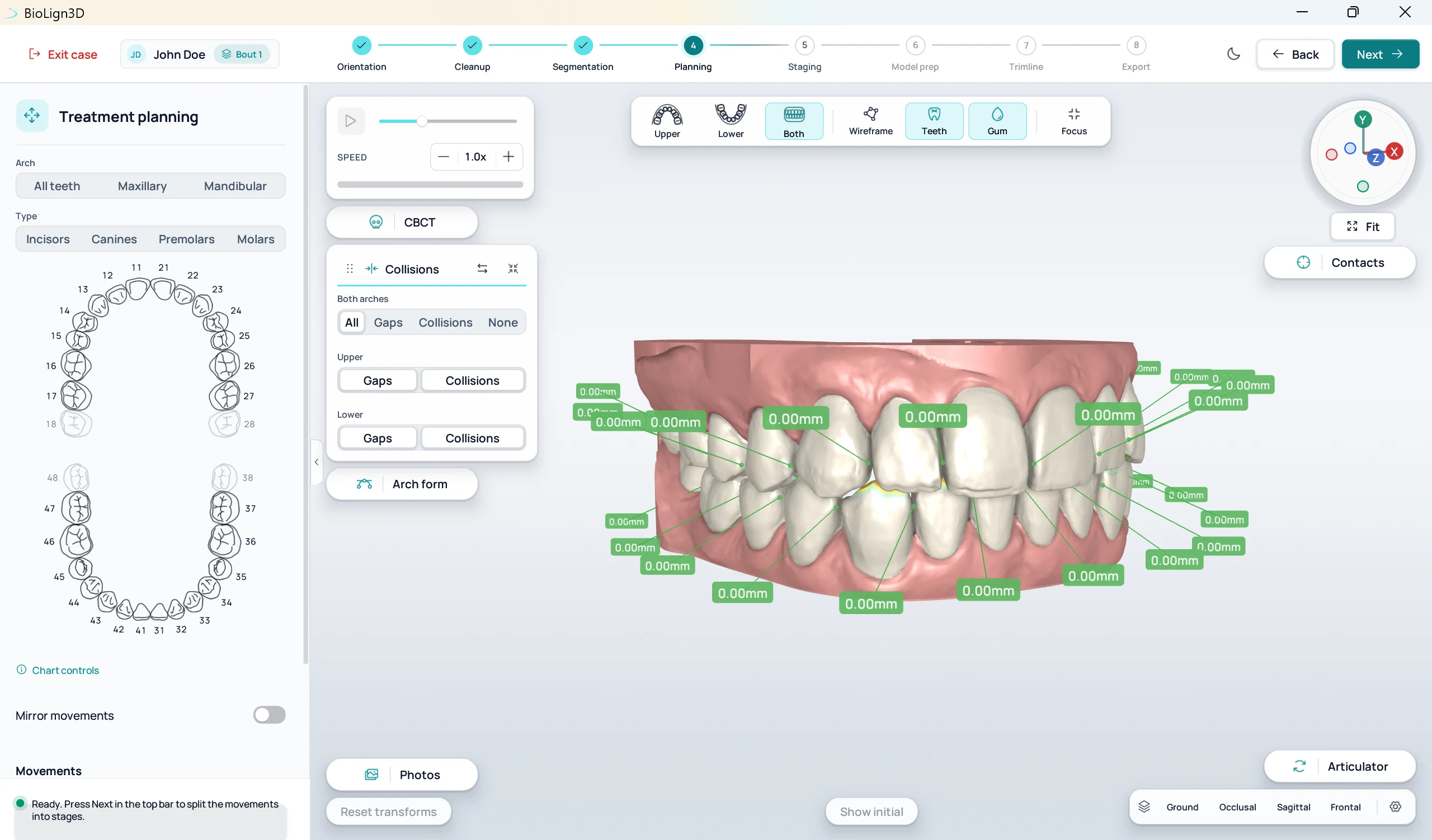BioLign3D treatment planning, front view, with per-tooth movement measurements